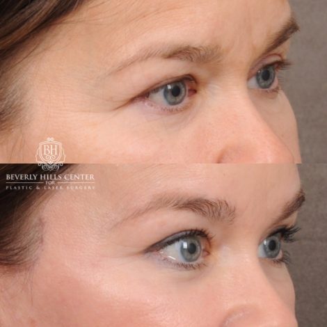 Beverly Hills Center Female Patient Before and After AuraLyft™, Temporal Brow Lift
