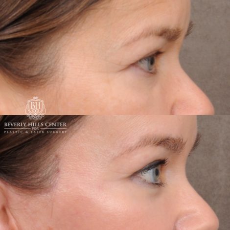 Beverly Hills Center Female Patient Before and After AuraLyft™, Temporal Brow Lift