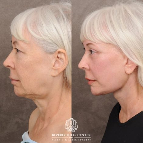 Beverly Hills Center Female Patient Before and After AuraLyft™, Temporal Brow Reset, Upper & Lower Blepharoplasty, Ptosis Repair, Cupid Lift™ Corner Lift, Fat Grafting