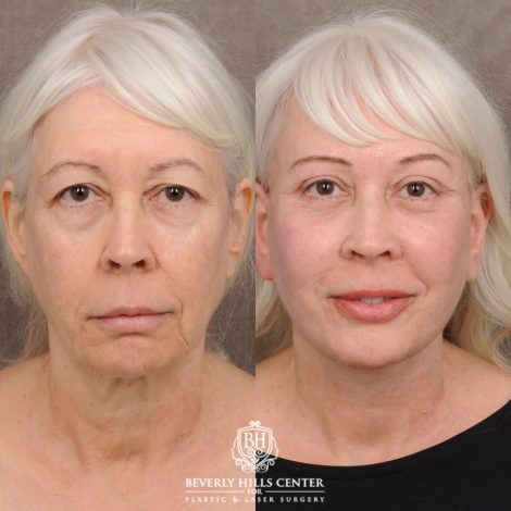 Beverly Hills Center Female Patient Before and After AuraLyft™, Temporal Brow Reset, Upper & Lower Blepharoplasty, Ptosis Repair, Cupid Lift™ Corner Lift, Fat Grafting