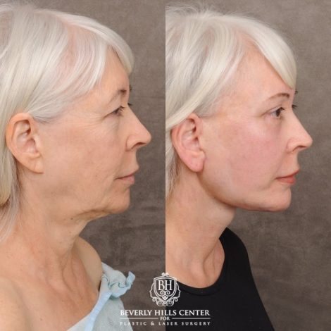 Beverly Hills Center Female Patient Before and After AuraLyft™, Temporal Brow Reset, Upper & Lower Blepharoplasty, Ptosis Repair, Cupid Lift™ Corner Lift, Fat Grafting
