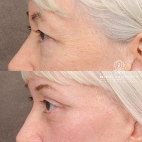 Beverly Hills Center Female Patient Before and After AuraLyft™, Temporal Brow Reset, Upper & Lower Blepharoplasty, Ptosis Repair, Cupid Lift™ Corner Lift, Fat Grafting