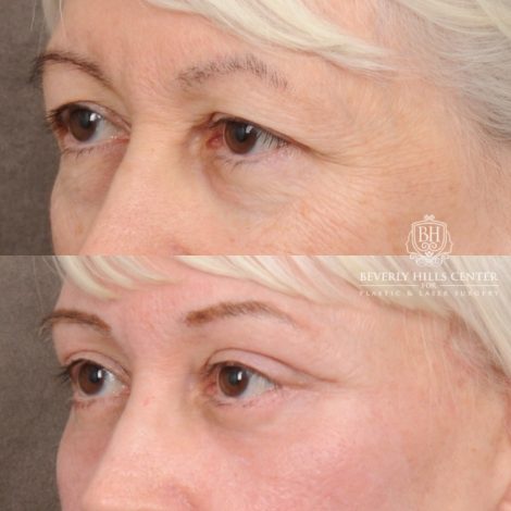 Beverly Hills Center Female Patient Before and After AuraLyft™, Temporal Brow Reset, Upper & Lower Blepharoplasty, Ptosis Repair, Cupid Lift™ Corner Lift, Fat Grafting