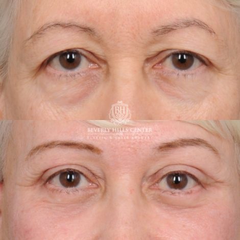 Beverly Hills Center Female Patient Before and After AuraLyft™, Temporal Brow Reset, Upper & Lower Blepharoplasty, Ptosis Repair, Cupid Lift™ Corner Lift, Fat Grafting