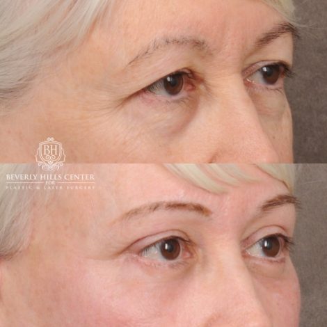 Beverly Hills Center Female Patient Before and After AuraLyft™, Temporal Brow Reset, Upper & Lower Blepharoplasty, Ptosis Repair, Cupid Lift™ Corner Lift, Fat Grafting