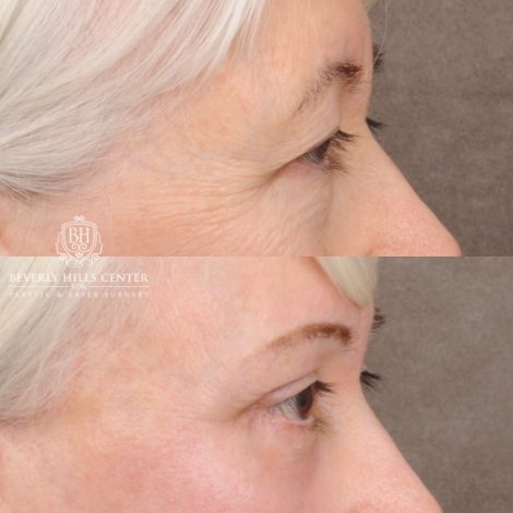 Beverly Hills Center Female Patient Before and After AuraLyft™, Temporal Brow Reset, Upper & Lower Blepharoplasty, Ptosis Repair, Cupid Lift™ Corner Lift, Fat Grafting