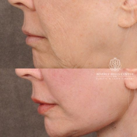 Beverly Hills Center Female Patient Before and After AuraLyft™, Temporal Brow Reset, Upper & Lower Blepharoplasty, Ptosis Repair, Cupid Lift™ Corner Lift, Fat Grafting