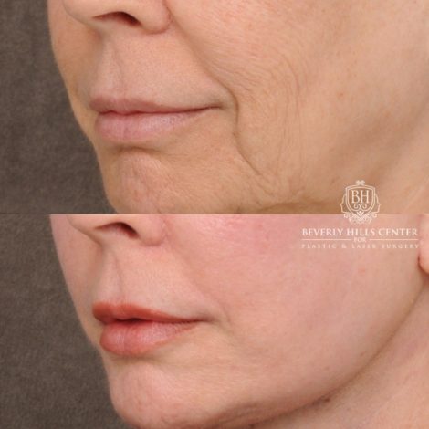 Beverly Hills Center Female Patient Before and After AuraLyft™, Temporal Brow Reset, Upper & Lower Blepharoplasty, Ptosis Repair, Cupid Lift™ Corner Lift, Fat Grafting