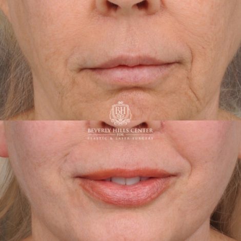 Beverly Hills Center Female Patient Before and After AuraLyft™, Temporal Brow Reset, Upper & Lower Blepharoplasty, Ptosis Repair, Cupid Lift™ Corner Lift, Fat Grafting