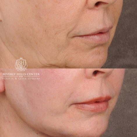 Beverly Hills Center Female Patient Before and After AuraLyft™, Temporal Brow Reset, Upper & Lower Blepharoplasty, Ptosis Repair, Cupid Lift™ Corner Lift, Fat Grafting