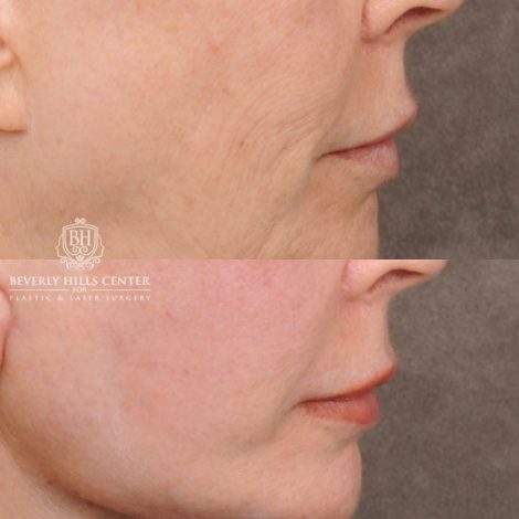 Beverly Hills Center Female Patient Before and After AuraLyft™, Temporal Brow Reset, Upper & Lower Blepharoplasty, Ptosis Repair, Cupid Lift™ Corner Lift, Fat Grafting