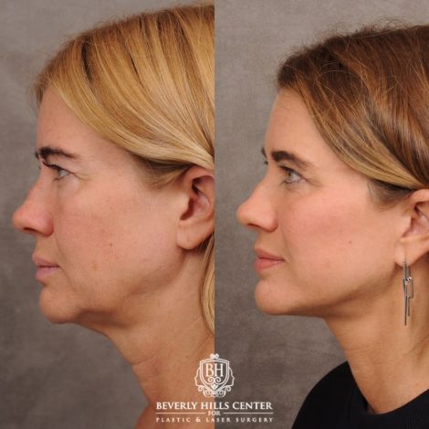 Beverly Hills Center Female Patient Before and After AuraLyft™