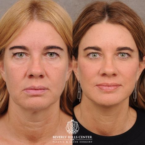 Beverly Hills Center Female Patient Before and After AuraLyft™
