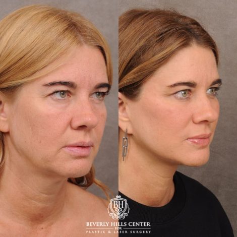 Beverly Hills Center Female Patient Before and After AuraLyft™