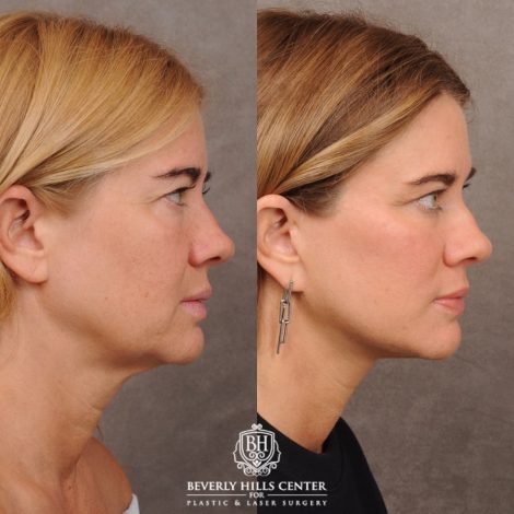 Beverly Hills Center Female Patient Before and After AuraLyft™