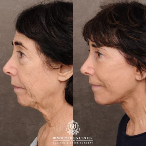Beverly Hills Center Female Patient Before and After AuraLyft™, Temporal Brow Reset, Upper & Lower Blepharoplasty, PHAT, CO2 (Mouth Area)