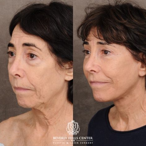Beverly Hills Center Female Patient Before and After AuraLyft™, Temporal Brow Reset, Upper & Lower Blepharoplasty, PHAT, CO2 (Mouth Area)