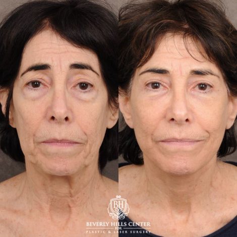 Beverly Hills Center Female Patient Before and After AuraLyft™, Temporal Brow Reset, Upper & Lower Blepharoplasty, PHAT, CO2 (Mouth Area)