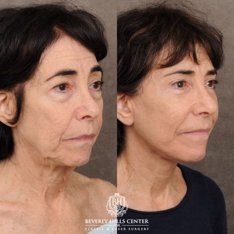 Beverly Hills Center Female Patient Before and After AuraLyft™, Temporal Brow Reset, Upper & Lower Blepharoplasty, PHAT, CO2 (Mouth Area)