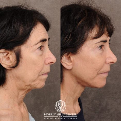 Beverly Hills Center Female Patient Before and After AuraLyft™, Temporal Brow Reset, Upper & Lower Blepharoplasty, PHAT, CO2 (Mouth Area)