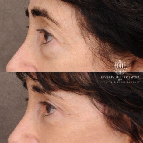 Beverly Hills Center Female Patient Before and After AuraLyft™, Temporal Brow Reset, Upper & Lower Blepharoplasty, PHAT, CO2 (Mouth Area)