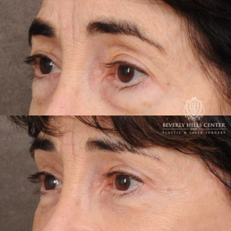 Beverly Hills Center Female Patient Before and After AuraLyft™, Temporal Brow Reset, Upper & Lower Blepharoplasty, PHAT, CO2 (Mouth Area)