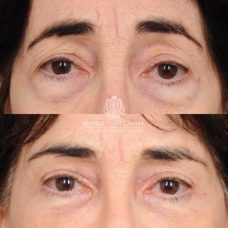Beverly Hills Center Female Patient Before and After AuraLyft™, Temporal Brow Reset, Upper & Lower Blepharoplasty, PHAT, CO2 (Mouth Area)