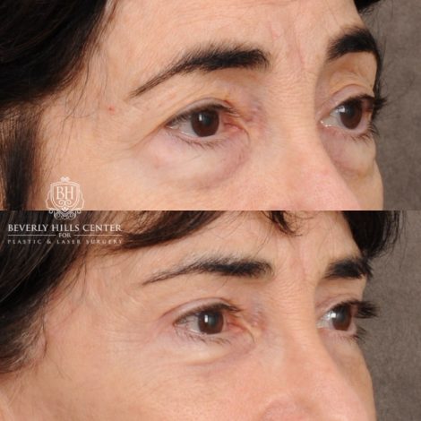 Beverly Hills Center Female Patient Before and After AuraLyft™, Temporal Brow Reset, Upper & Lower Blepharoplasty, PHAT, CO2 (Mouth Area)