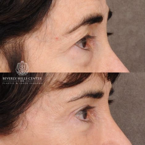 Beverly Hills Center Female Patient Before and After AuraLyft™, Temporal Brow Reset, Upper & Lower Blepharoplasty, PHAT, CO2 (Mouth Area)