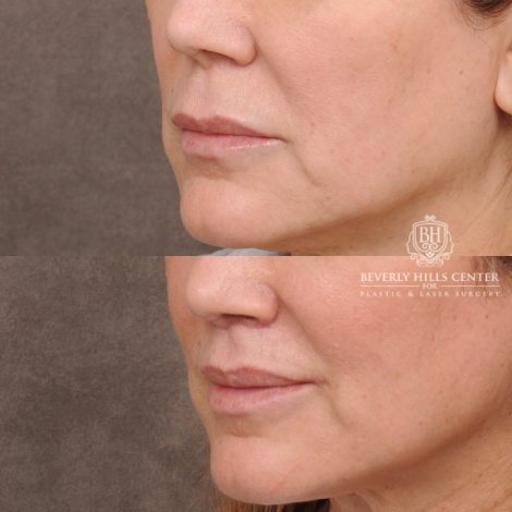 Beverly Hills Center Female Patient Before and After Cupid Lift®