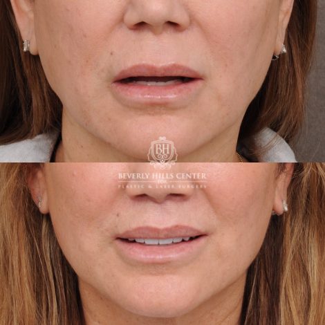 Beverly Hills Center Female Patient Before and After Cupid Lift®