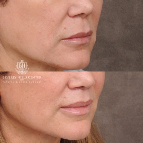 Beverly Hills Center Female Patient Before and After Cupid Lift®
