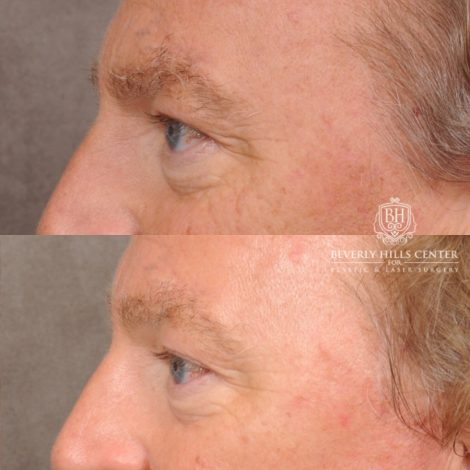 Beverly Hills Center Male Patient Before and After AuraLyft™, Temporal Brow Reset