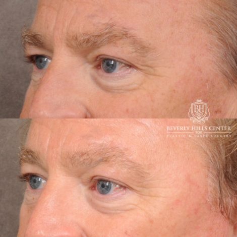Beverly Hills Center Male Patient Before and After AuraLyft™, Temporal Brow Reset