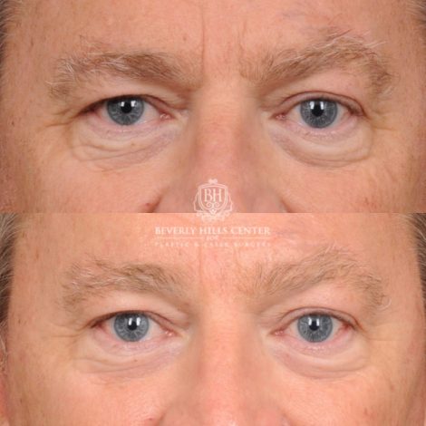 Beverly Hills Center Male Patient Before and After AuraLyft™, Temporal Brow Reset