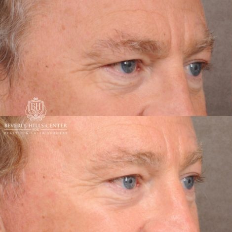 Beverly Hills Center Male Patient Before and After AuraLyft™, Temporal Brow Reset