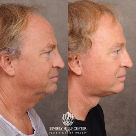 Beverly Hills Center Male Patient Before and After AuraLyft™, Temporal Brow Reset