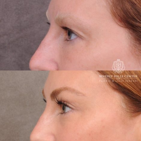 Beverly Hills Center Female Patient Before and After Upper Blepharoplasty & Temporal Brow Reset