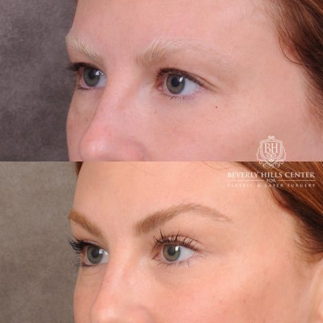 Beverly Hills Center Female Patient Before and After Upper Blepharoplasty & Temporal Brow Reset