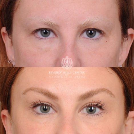 Beverly Hills Center Female Patient Before and After Upper Blepharoplasty & Temporal Brow Reset