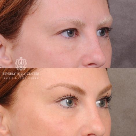 Beverly Hills Center Female Patient Before and After Upper Blepharoplasty & Temporal Brow Reset