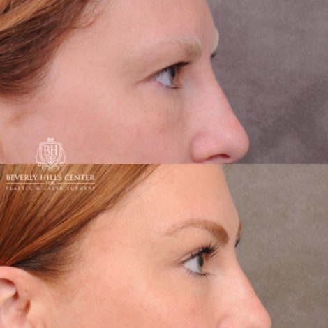 Beverly Hills Center Female Patient Before and After Upper Blepharoplasty & Temporal Brow Reset