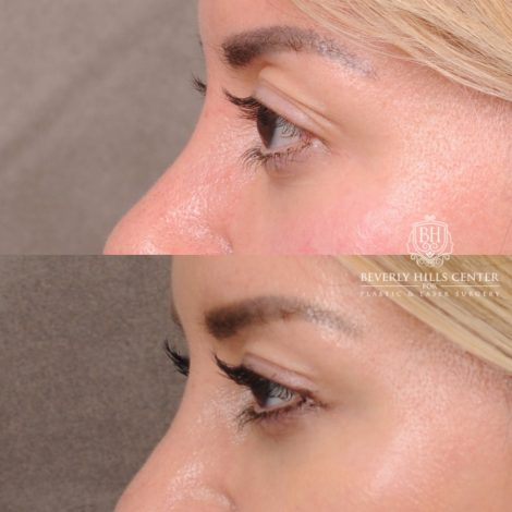 Beverly Hills Center Female Patient Before and After Upper Blepharoplasty with Ptosis Repair