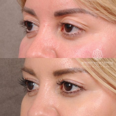 Beverly Hills Center Female Patient Before and After Upper Blepharoplasty with Ptosis Repair