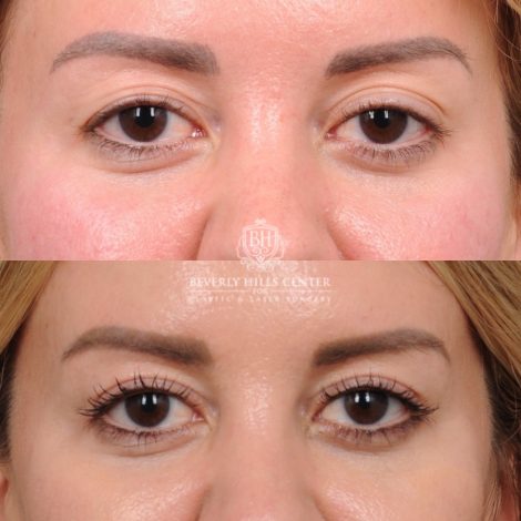 Beverly Hills Center Female Patient Before and After Upper Blepharoplasty with Ptosis Repair