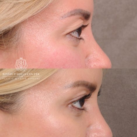 Beverly Hills Center Female Patient Before and After Upper Blepharoplasty with Ptosis Repair