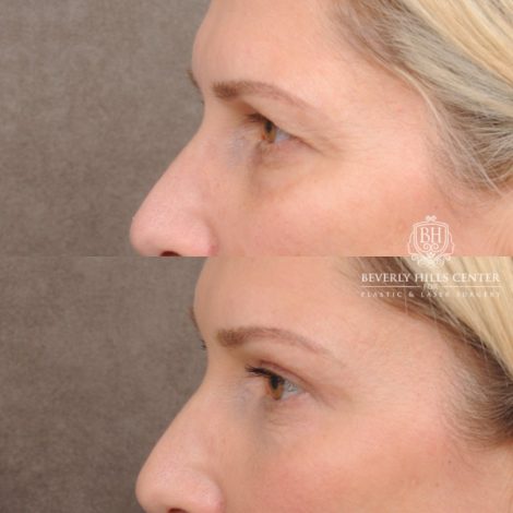 Beverly Hills Center Female Patient Before and After Upper Blepharoplasty, Temporal Brow Reset, Fat grafting