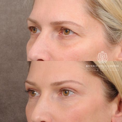 Beverly Hills Center Female Patient Before and After Upper Blepharoplasty, Temporal Brow Reset, Fat grafting