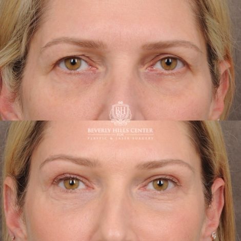 Beverly Hills Center Female Patient Before and After Upper Blepharoplasty, Temporal Brow Reset, Fat grafting
