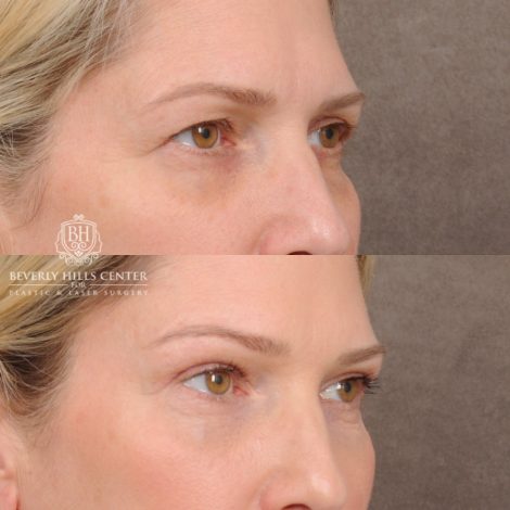 Beverly Hills Center Female Patient Before and After Upper Blepharoplasty, Temporal Brow Reset, Fat grafting